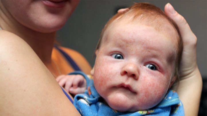Baby eczema tips from Dr Golly